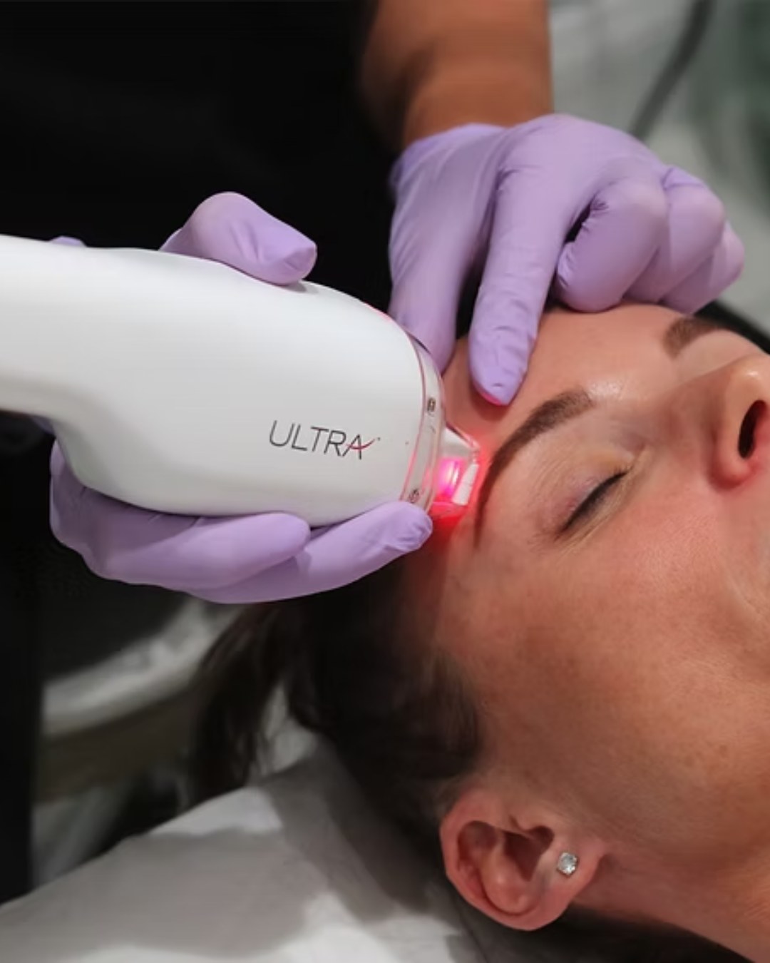 LaseMD Ultra Laser Resurfacing at Sense Medical Spa
