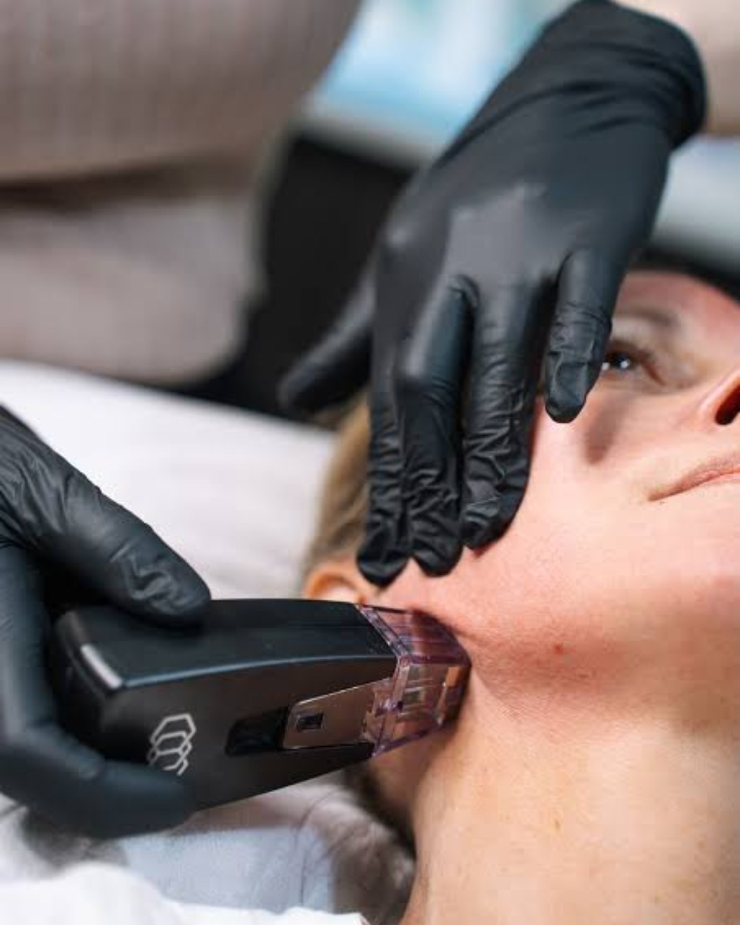 Non Surgical Face Lift at Sense Medical Spa