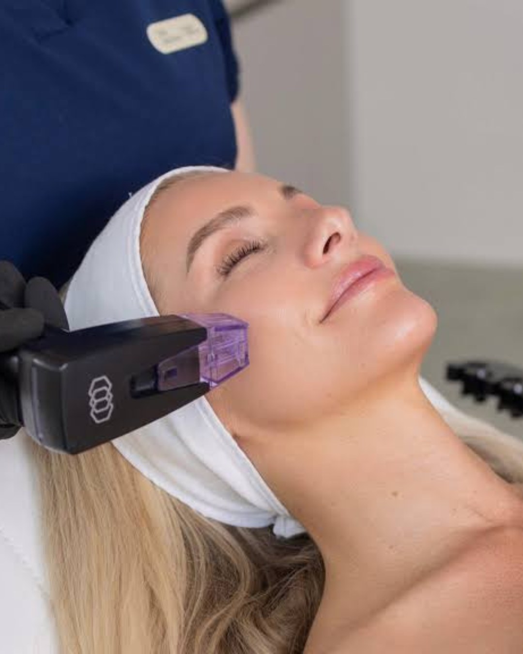 Morpheus8 radiofrequency microneedling of the jawline at Sense Medical Spa, Port Chester NY